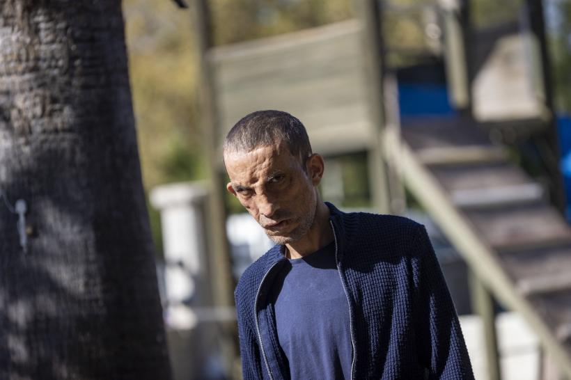 Prima persoană care a făcut un transplant de față în Turcia, Ugur Acar, surprins într-o ședință foto 18807816