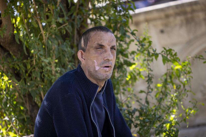 Prima persoană care a făcut un transplant de față în Turcia, Ugur Acar, surprins într-o ședință foto 18807818