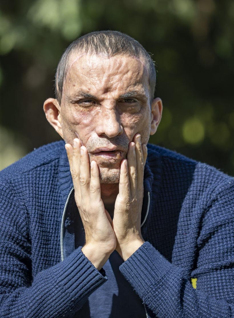 Prima persoană care a făcut un transplant de față în Turcia, Ugur Acar, surprins într-o ședință foto 18807820