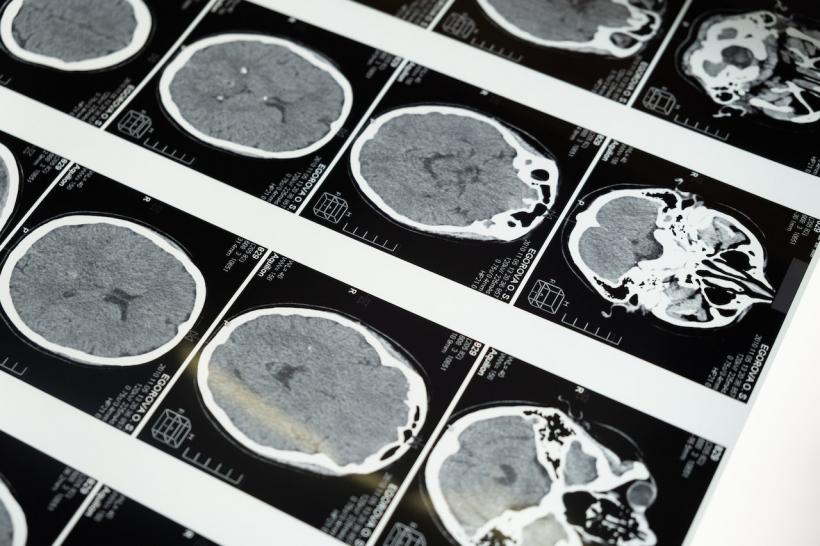 5 boli neurologice și ce trebuie să știi despre ele