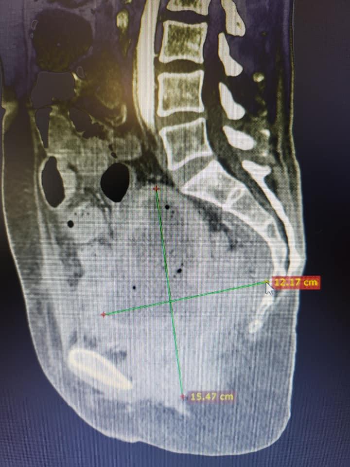 Tânără de 37 de ani trimisă să moară, salvată de medicii din Brașov: De cele mai multe ori imposibilul e posibil! 18820393