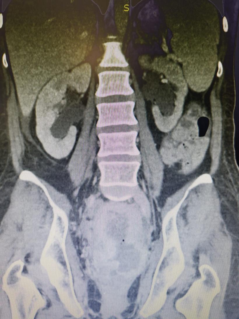 Tânără de 37 de ani trimisă să moară, salvată de medicii din Brașov: De cele mai multe ori imposibilul e posibil! 18820394