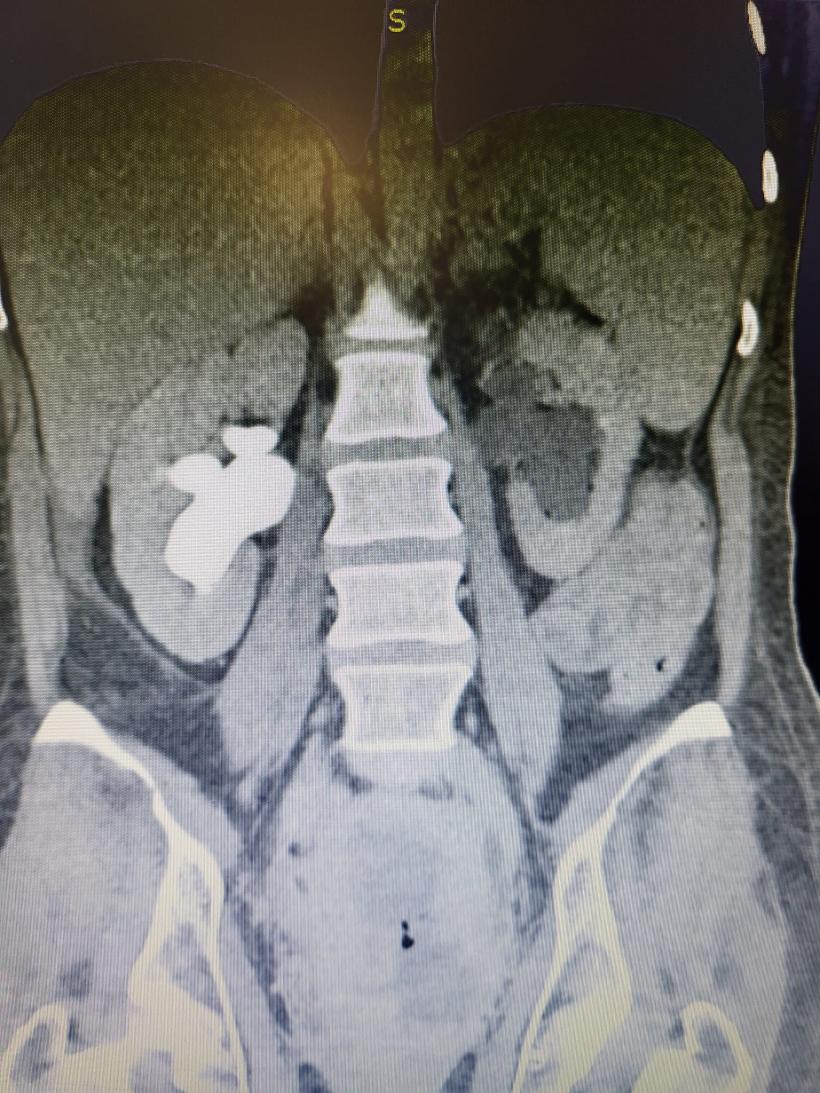 Tânără de 37 de ani trimisă să moară, salvată de medicii din Brașov: De cele mai multe ori imposibilul e posibil! 18820397