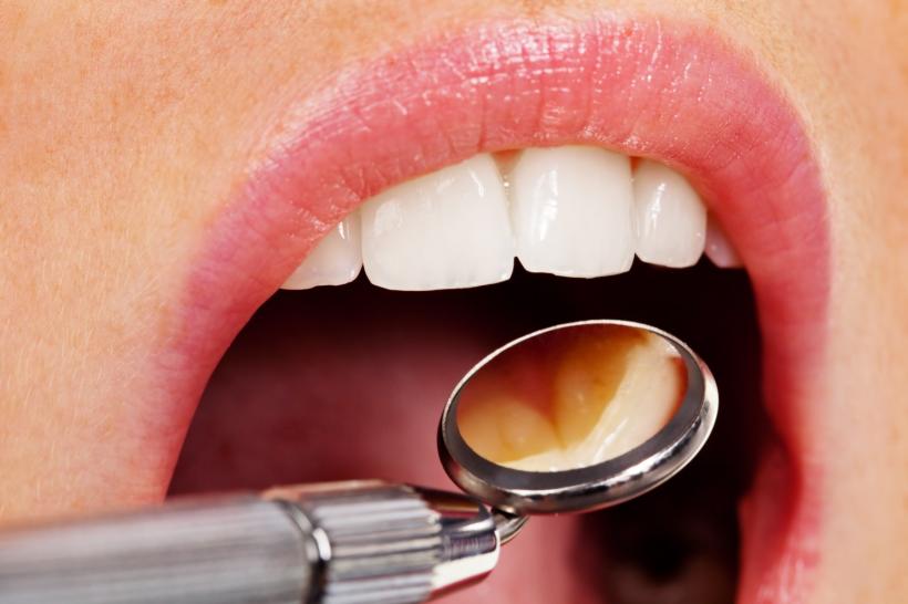 Problemele dentare şi igiena orală precară afectează semnificativ creierul și inima 