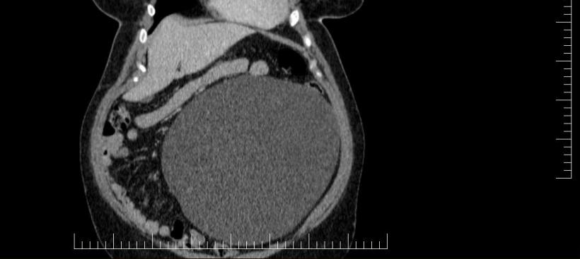 Performanță medicală la Sibiu: Chist ovarian de 4,5 kilograme, extirpat cu succes de la o pacientă 18830373