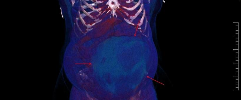 Performanță medicală la Sibiu: Chist ovarian de 4,5 kilograme, extirpat cu succes de la o pacientă 18830374