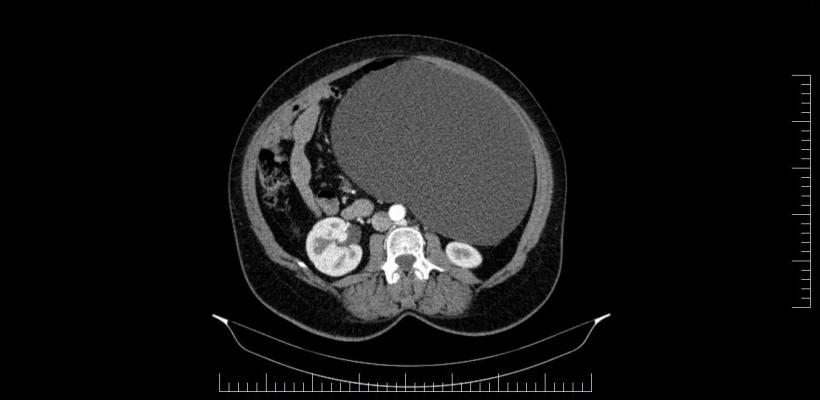 Performanță medicală la Sibiu: Chist ovarian de 4,5 kilograme, extirpat cu succes de la o pacientă 18830375