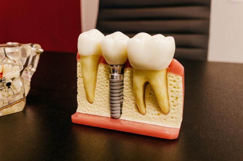 Implantul dentar - o opțiune modernă și durabilă pentru îmbunătățirea sănătății dentare