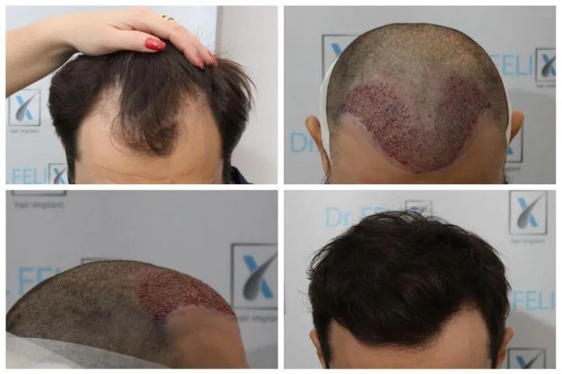 (P) Cauze comune ale căderii părului - află de implant de păr realizat la clinica Dr. Felix Hair Implant