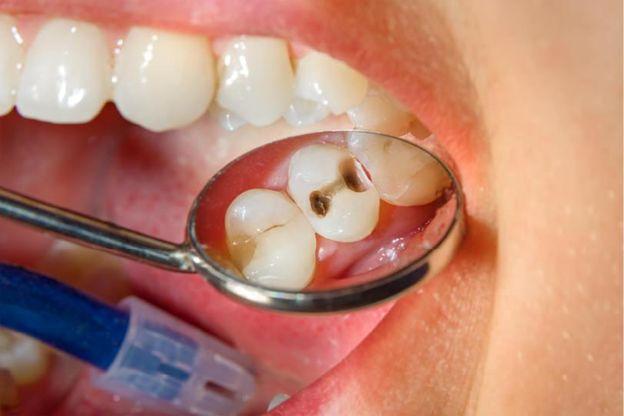 De ce apar cariile dentare si cum le poti preveni