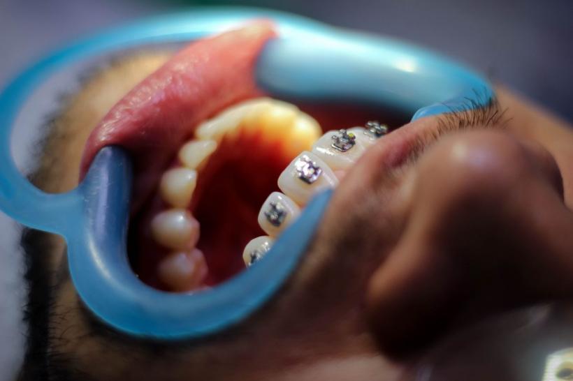 Trei descoperiri care i-au lăsat pe dentiști cu gura căscată