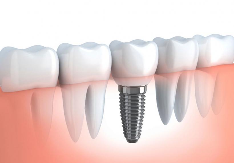 Ce trebuie să știm despre implantul dentar. Demontarea unui mit: &quot;Nu trebuie scos&quot;