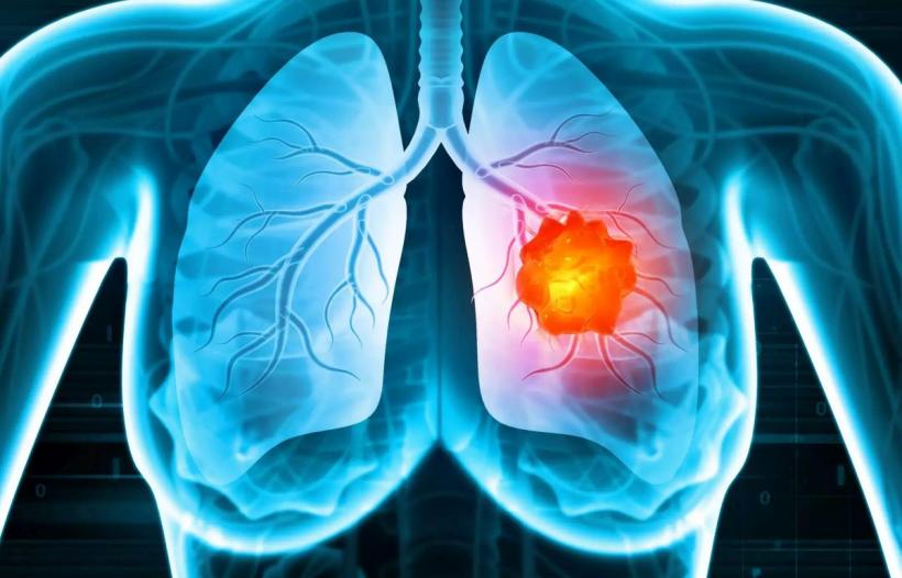 Pacienții cu cancer pulmonar se confruntă cu cel mai ridicat nivel de depresie