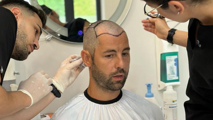 Aspect Natural și Rezultate Durabile: Implantul de Păr în România 18864532