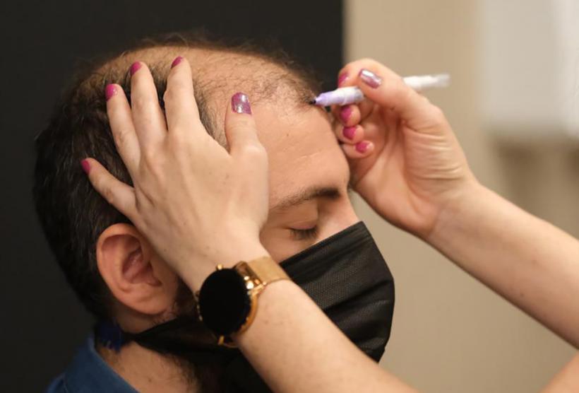 Aspect Natural și Rezultate Durabile: Implantul de Păr în România 18864533