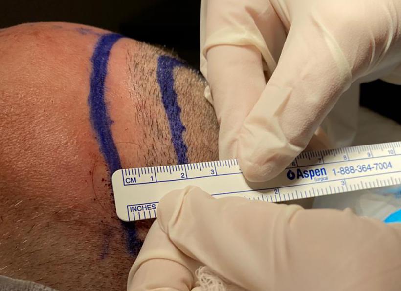 Aspect Natural și Rezultate Durabile: Implantul de Păr în România 18864534