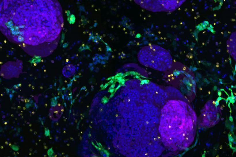 Inteligența artificială detectează cancerul pancreatic cu 18 luni înainte de diagnostic 18882776