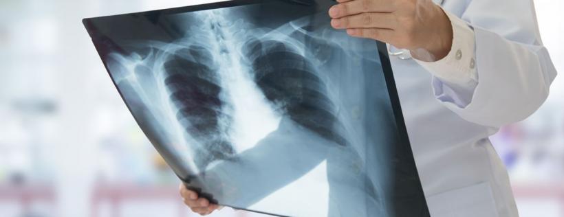 O nouă cauză a leziunilor pulmonare descoperită de oameni de știință