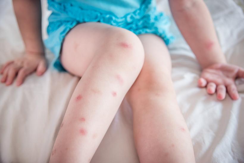 Cum se manifestă dermatofitoza la copii. Cauze și tratament