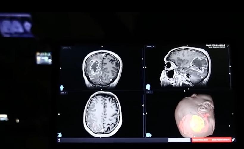 Lacrimi de fericire. Bărbat cu tumoră cerebrală gigant, operat cu succes la Spitalul „Nicolae Oblu” din Iași: E o minune 18900584