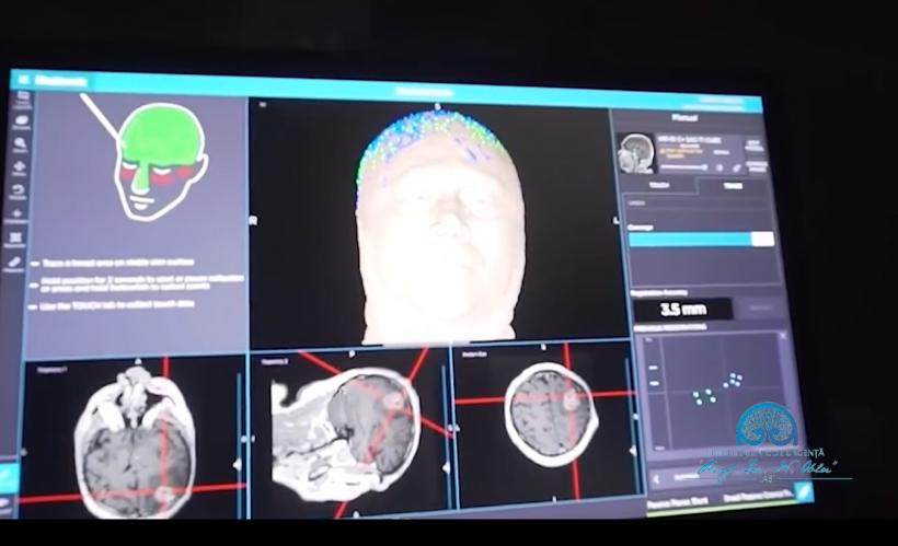 Premieră în România: Primul copil operat pe creier în semiîntuneric de o tumoră gigant de 10 cm 18901155