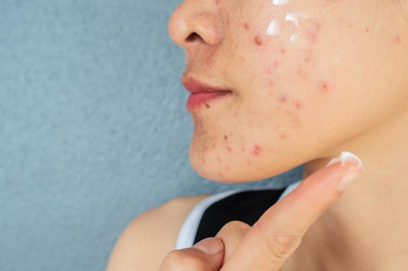 Cauzele apariției acneii fungice. Simptome și tratament