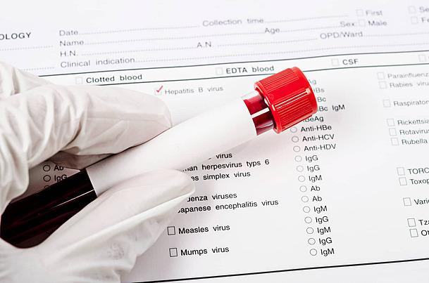 Un simplu test de sânge furnizează rezultate promiţătoare în detectarea bolii Alzheimer