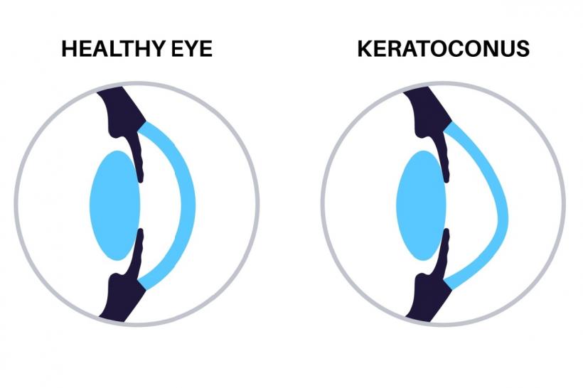 Keratoconus: cauze, simptome și opțiuni de tratament