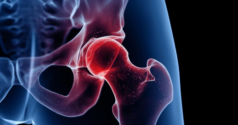 Osteoporoza, o afecțiune „silențioasă” depistată tardiv, deși este ușor de diagnosticat 18922750