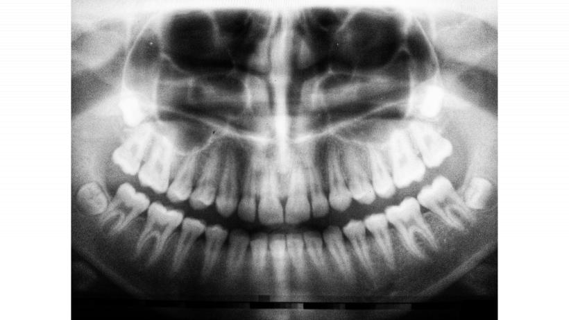 Top 3 avantaje ale implanturilor dentare