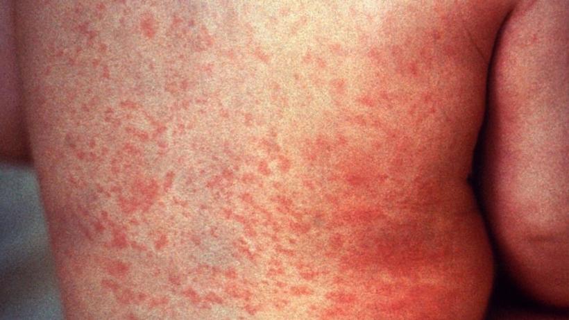 Rujeola poate devasta sistemul imunitar și creierul