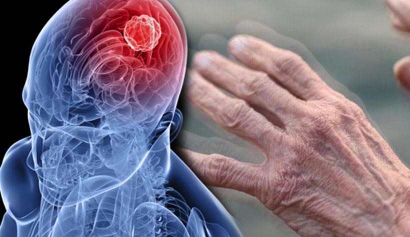 Descoperire în medicină. Un test de sânge ar putea detecta boala Parkinson înainte de apariția simptomelor