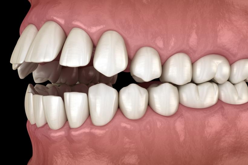 Cum să recunoști și cum se tratează o mușcătură deschisă? 