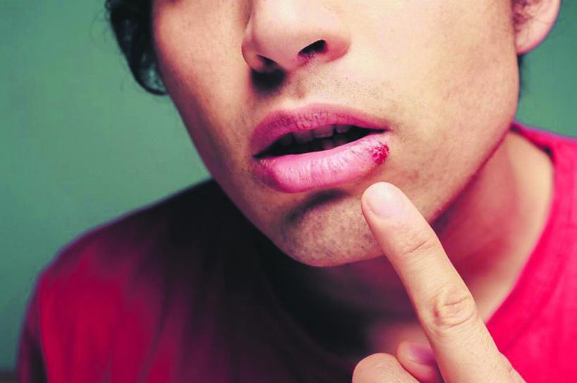 Cum tratezi un herpes cu ingrediente naturale: 5 remedii casnice eficiente