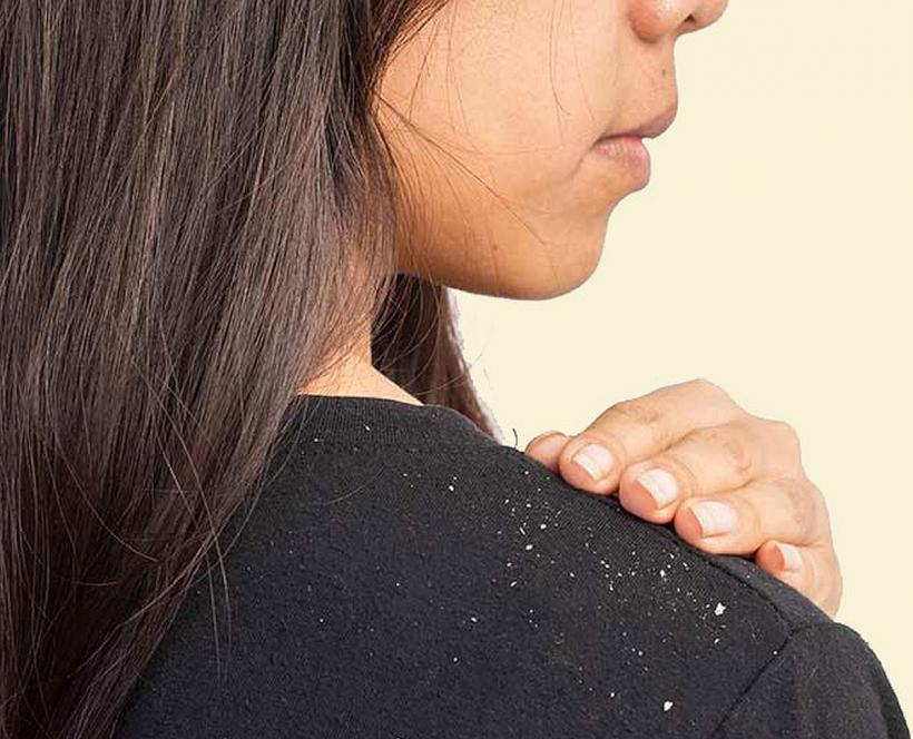 Metode naturale care te ajută să scapi rapid de mătreață