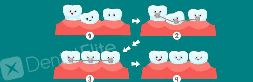 Zâmbetul pe care ți-l dorești: tehnici moderne de îndreptare a dinților