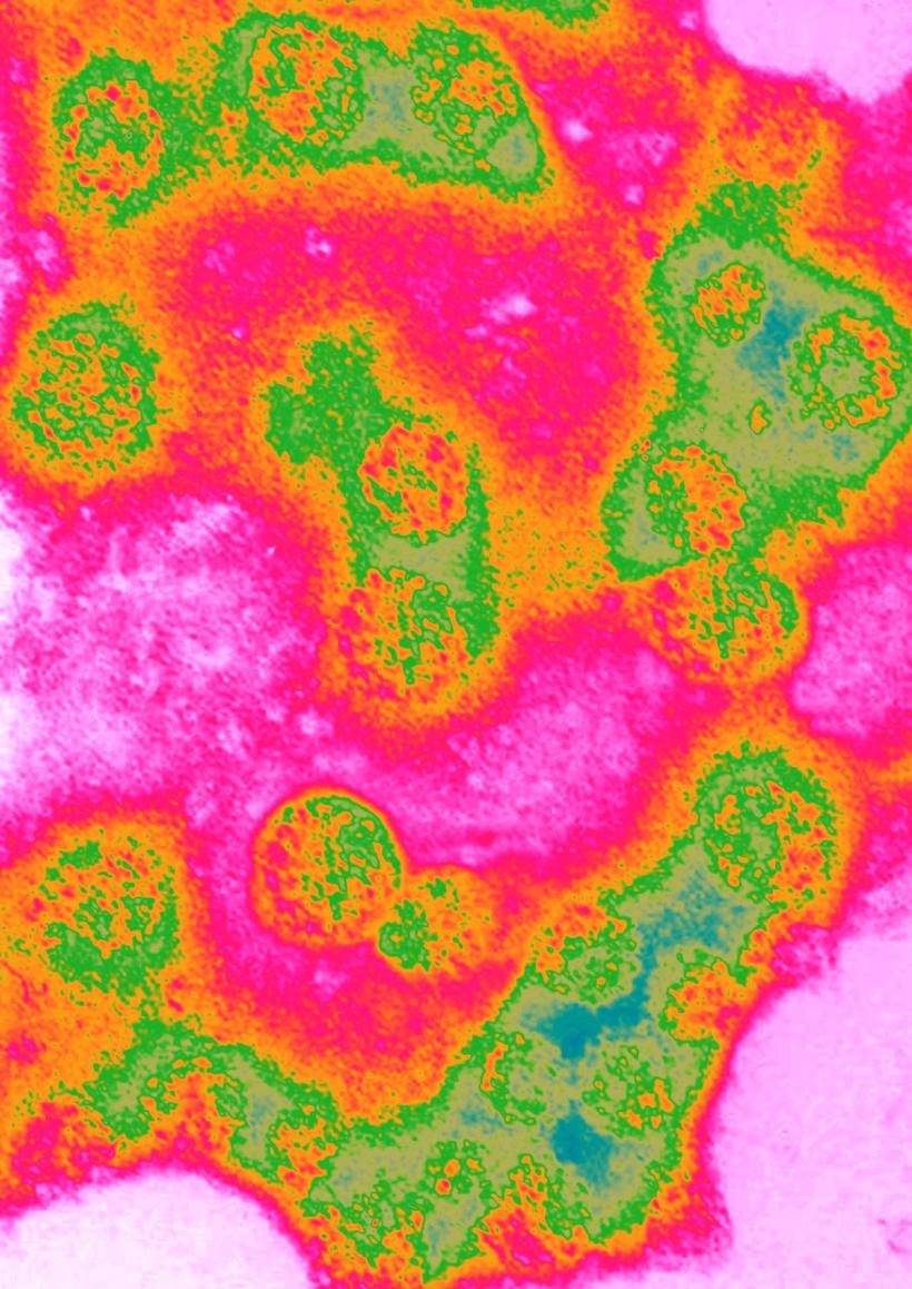 Cancerul de colon a devenit principala cauză de deces prin cancer la persoanele sub 50 de ani