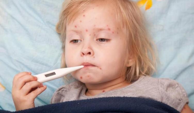 Focar de rujeolă în Londra: Peste 60 de copii infectați. Este posibil ca epidemia să se extindă