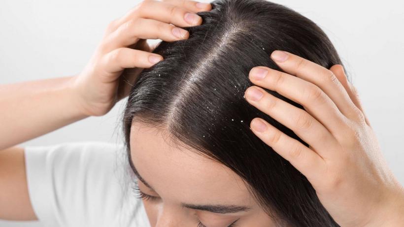 Seleniu beneficii: alege un șampon antimătreață eficient