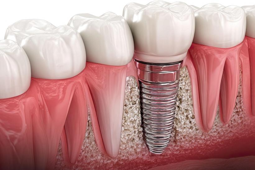 Când pacienții caută o soluție rapidă pentru o dantură stabilă și confortabilă