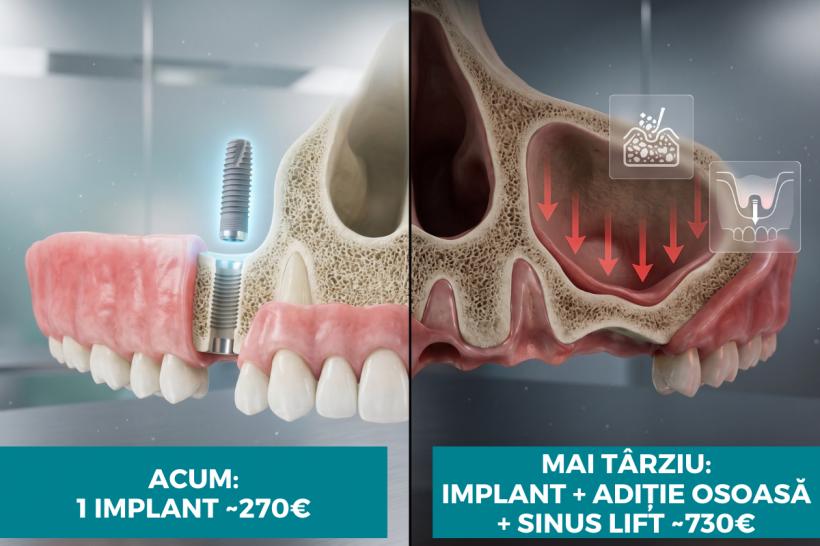 Cât te costă, de fapt, să nu îți pui implant dentar la timp?  