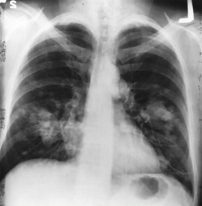 Pentru o îngrijire pulmonară completă - de la primele simptome ale cancerului pulmonar la medicul specialist,  platforma grijadeplamani.ro adaugă o nouă funcționalitate: harta clinicilor și cabinetelor medicale cu secții de pneumologie din România