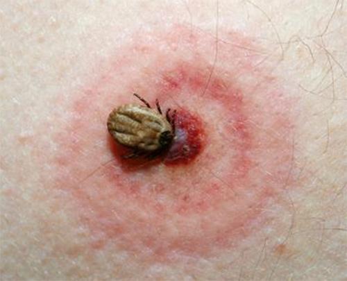 Mușcătura de căpușă poate provoca o alergie severă: Sindromul care sperie medicii