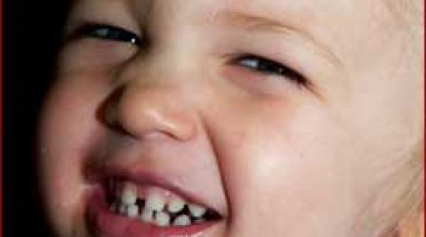 bruxismul poate fi nocturn sau diurn