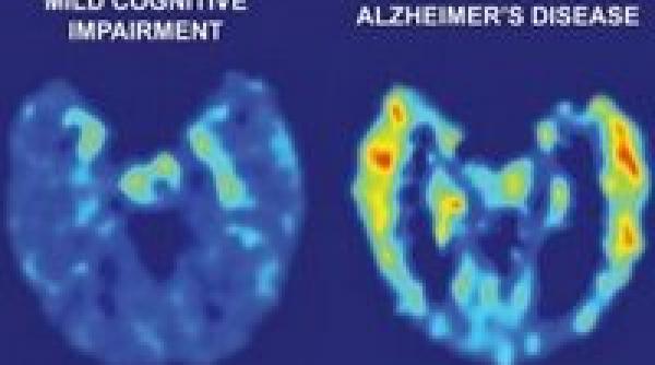 maladia alzhaimer poate fi tratata