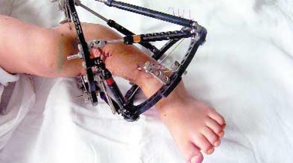 modelarea piciorului chirurgie ortopedica moderna