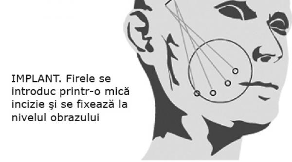 operatie pentru fata paralizata