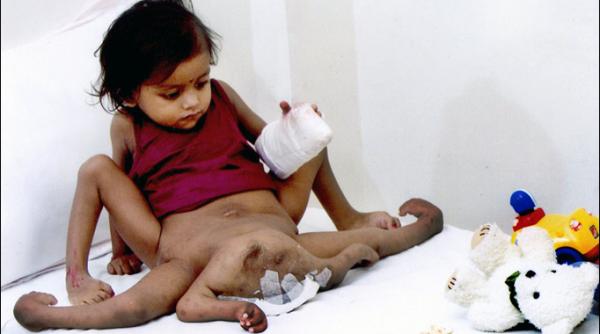 nepal un copil s a nascut cu opt membre