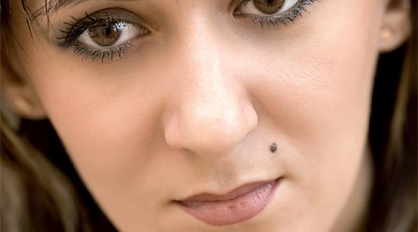 cu alunitele la medic