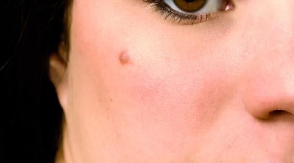 cum scapam de alunite